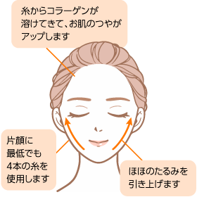 お顔の糸リフト