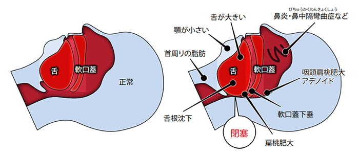 睡眠時無呼吸症候群のメカニズム