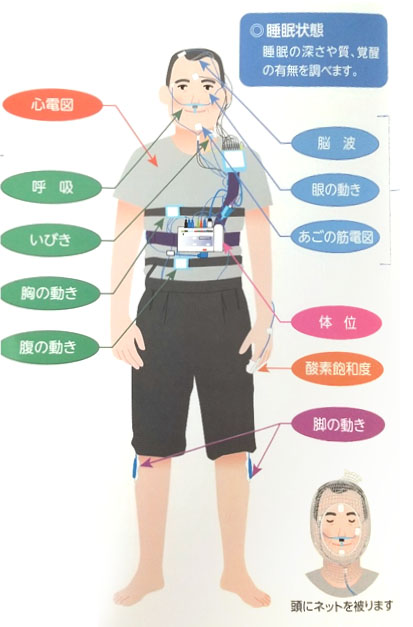 PSG検査の概略図