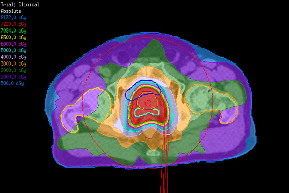 前立腺がんに対するIMRTの放射線量分布図