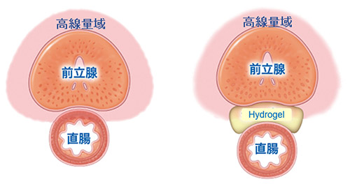 前立腺と接する直腸