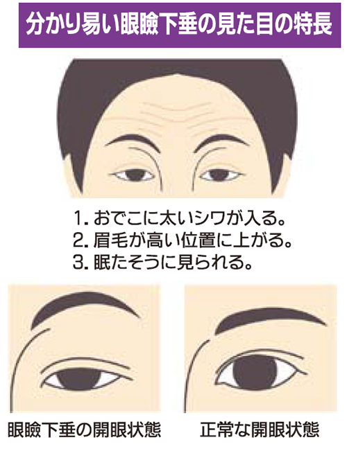 眼瞼下垂 がんけんかすい 広報誌 東名厚木病院 社会医療法人社団 三思会